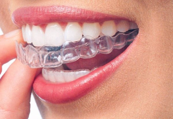 Invisalign – sistem providnih folija za ispravljanje zuba