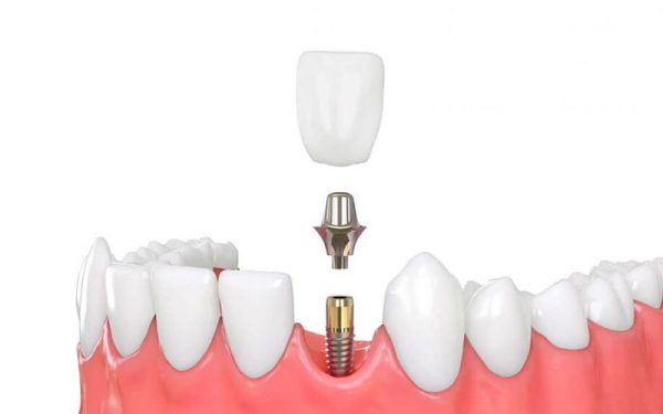 Dentalni implanti: Šta možete očekivati?