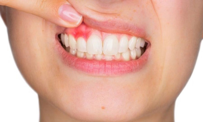 sta je gingivitis