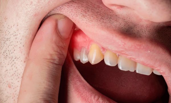 Read more about the article Paradontopatija: Šta je, koji su uzroci ove bolesti i kako se leči?
