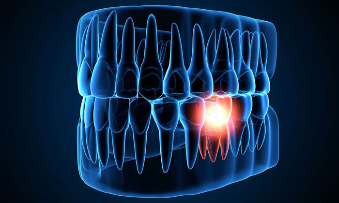 pulpitis