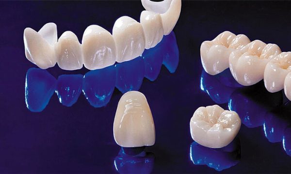 Read more about the article Zirconia krunice vs E-max krunice: 10 Saveta za savršen izbor